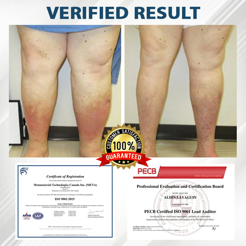 ATTDX® EdemaEase Black Cumin Therapy Cream