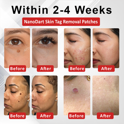 ATTDX® NanoDart Skin Tag Removal Patches