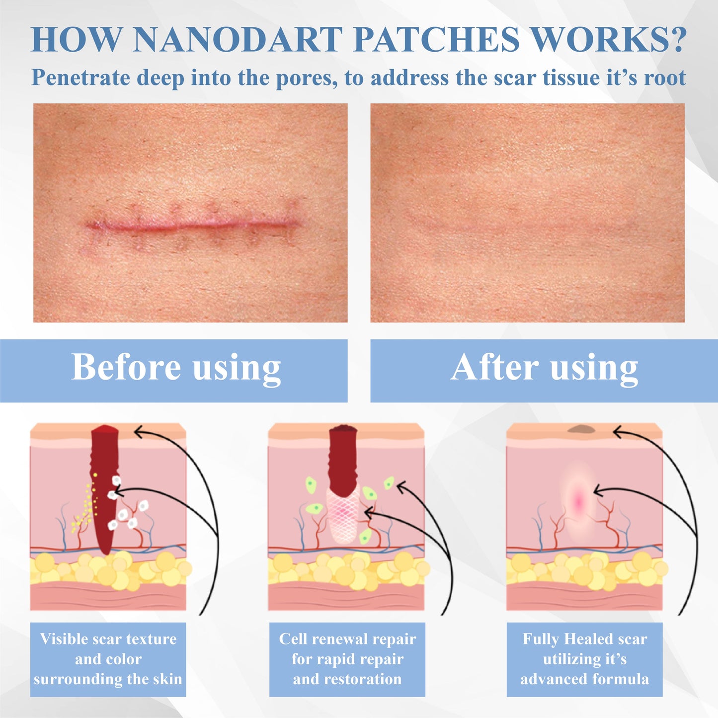 ATTDX® ScarRepair EGF Nanodart Patches