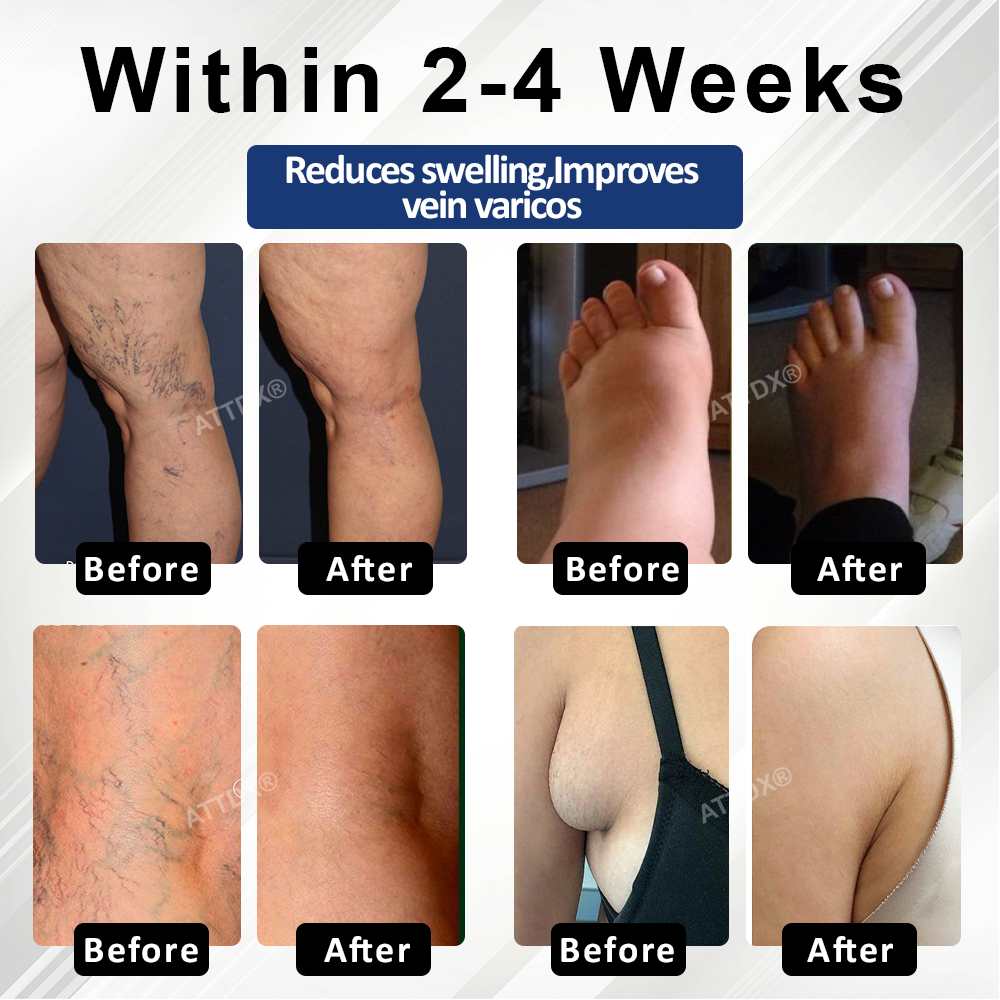 ATTDX® VenoHerb Black Cumin Edema Relief Balm