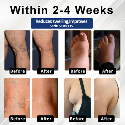 ATTDX® VenoHerb Black Cumin Edema Relief Balm
