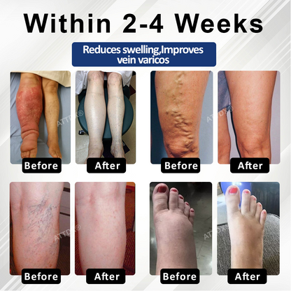 ATTDX® VenoHerb Black Cumin Edema Relief Balm