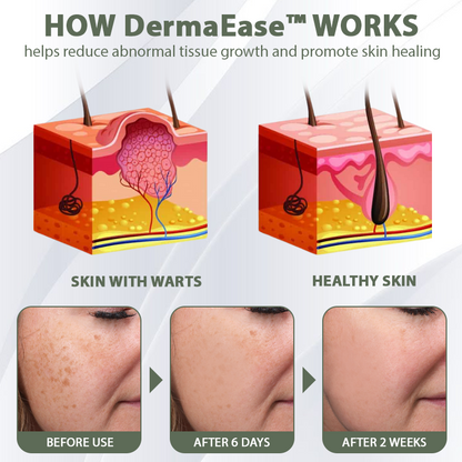 DermaEase™ Spotless Tag and WartRemoval Gel